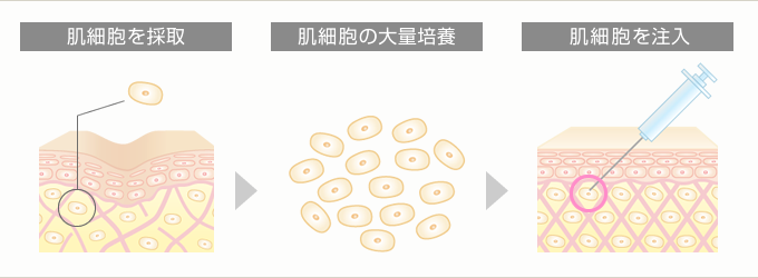 肌細胞を採取、肌細胞の大量培養、肌細胞を注入。